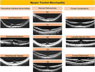 The Role of Internal Limiting Membrane as a Biomarker in the Evolution of Myopic Traction Maculopathy
